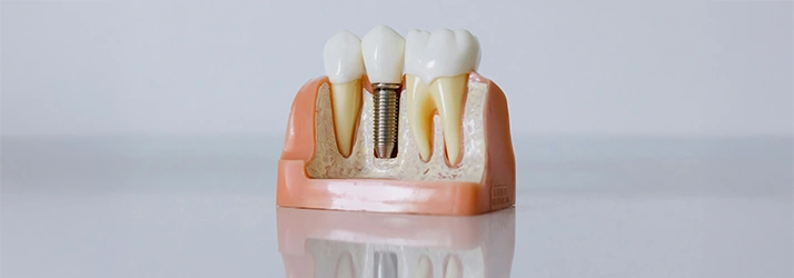 A detailed model showcasing a dental implant